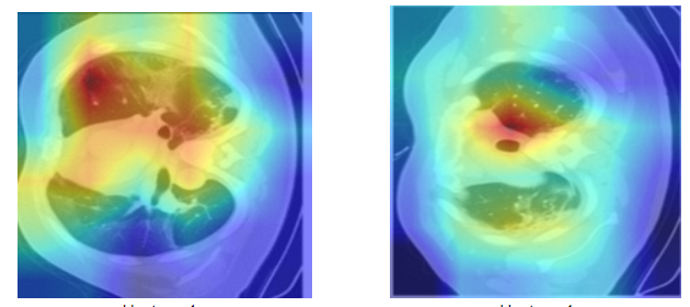 Covid Detection through CT scans